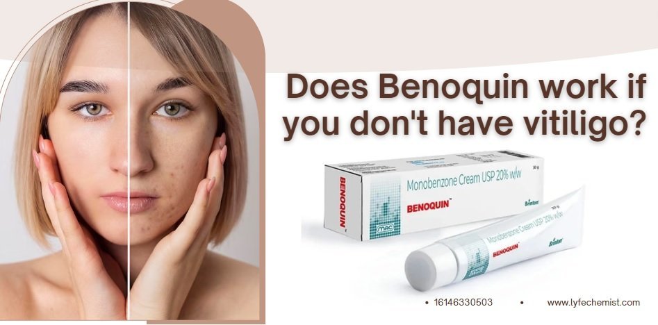 can-normal-person-use-benoquin-cream